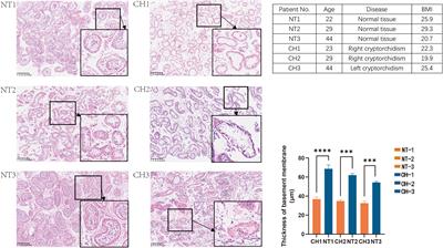 RNA sequencing profiles reveals progressively reduced spermatogenesis with progression in adult cryptorchidism